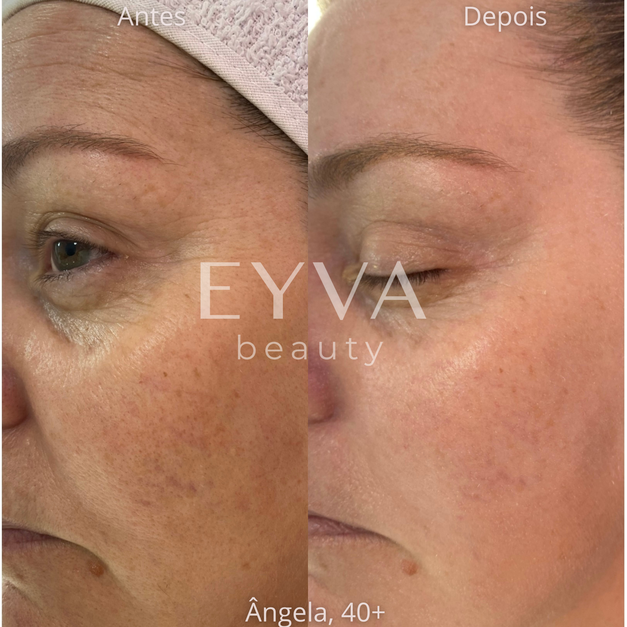 Comparativo antes e depois da região dos olhos de Ângela, 40+