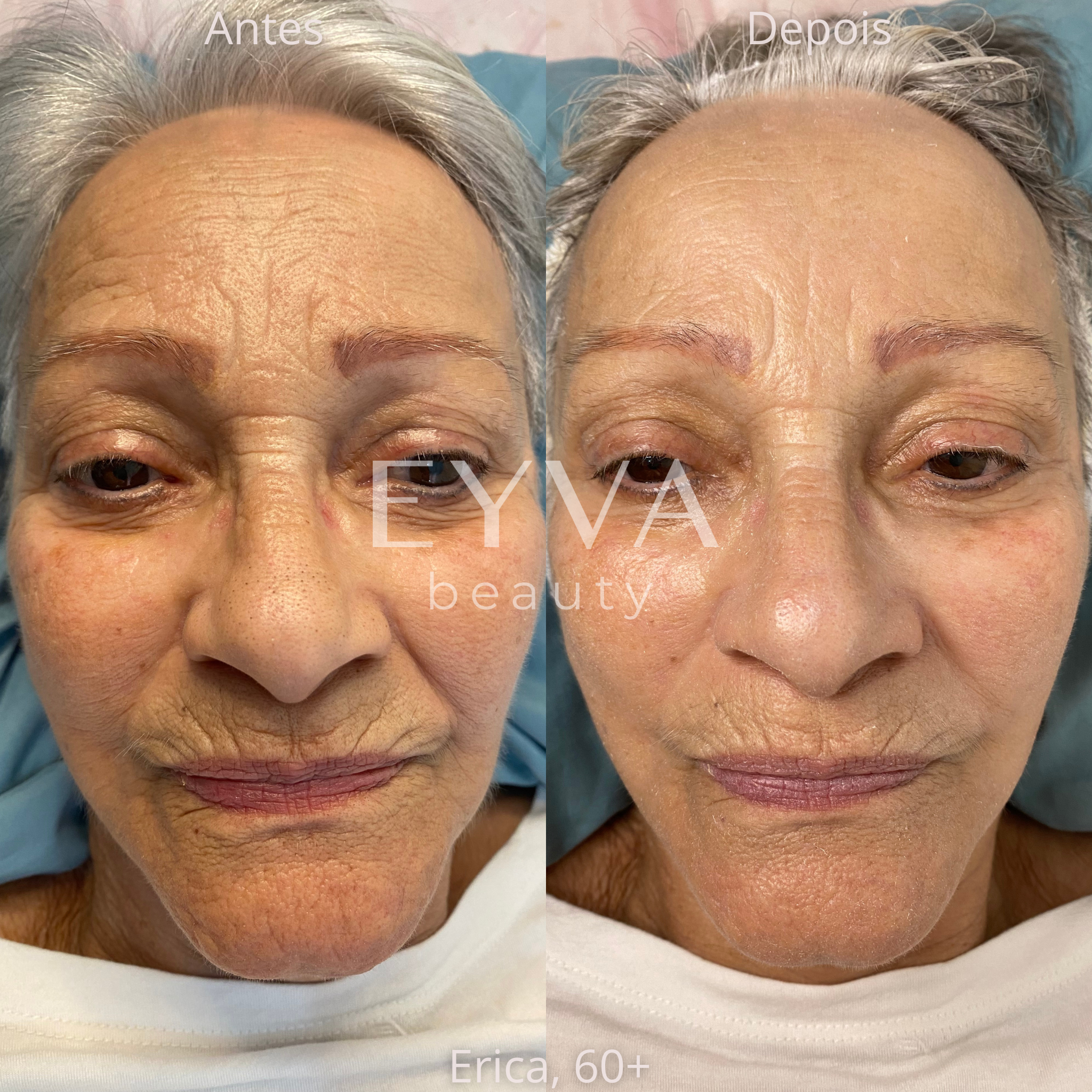 Comparativo antes e depois de Érica, 60+