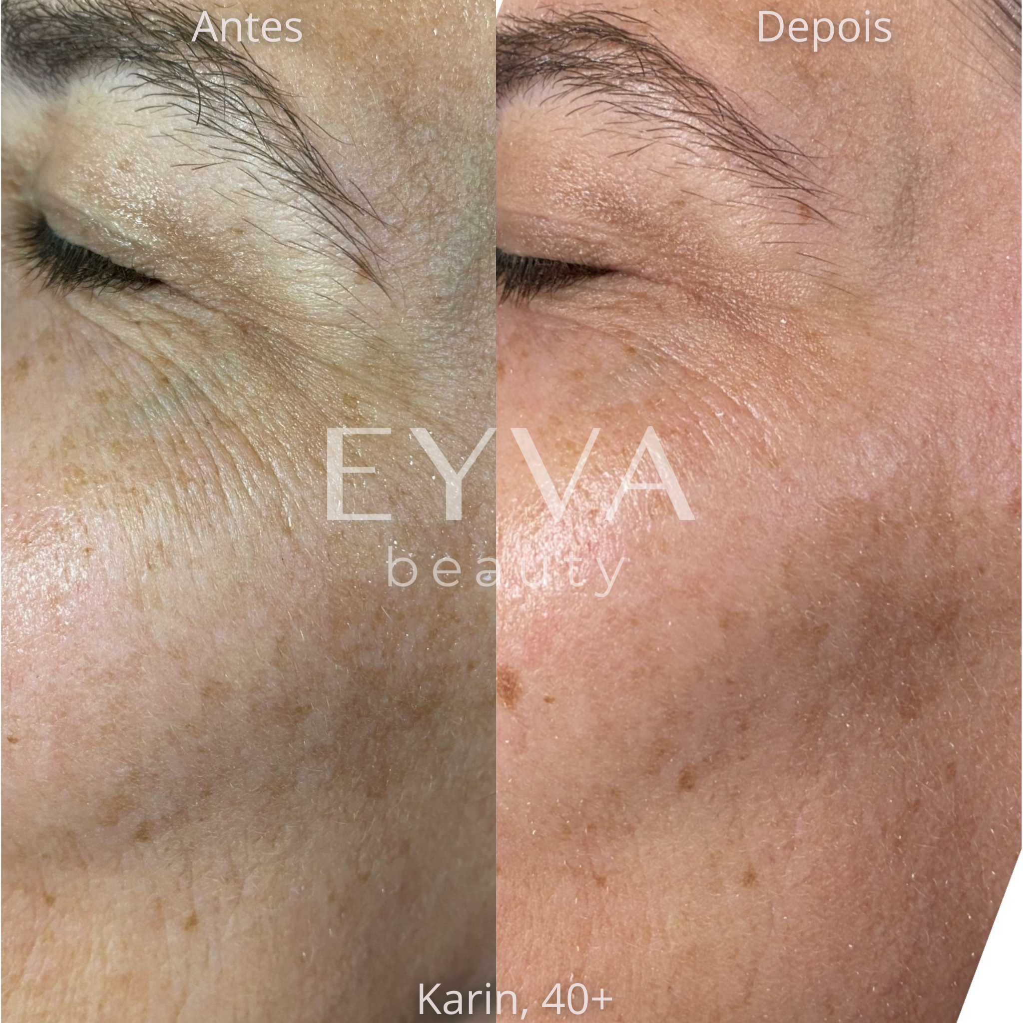 Comparativo antes e depois da região dos olhos de Karin, 40+